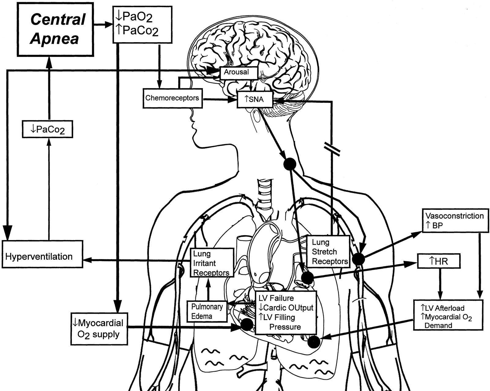 central-sleep-apnea-in-heart-failure-hf-apnea-congestive-heart